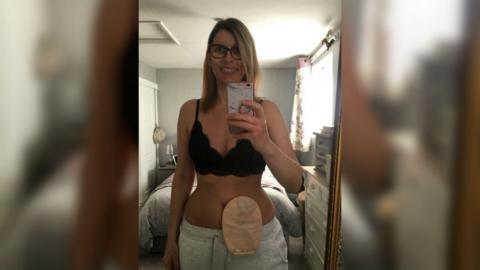 Zoe Young with stoma bag