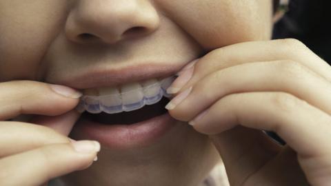 Woman putting in clear aligners