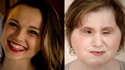 Katie Stubblefield, before her accident and after her face transplant.