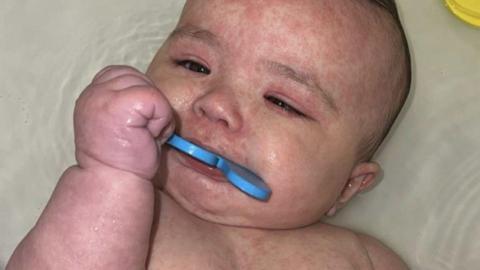 A photo of Kimie with a visible red rash on her body, a common symptom of measles.