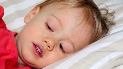 Child in bed with scarlet fever