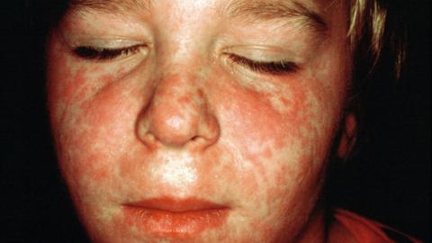 Child with measles