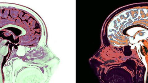 MRI brain scans