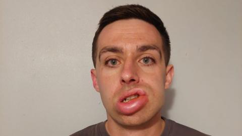 Jack Cope is standing in front of a white wall. He has short brown hair and is wearing a grey T-shirt. The left side of his face (the right when looking at the image) is swollen, including his lip.