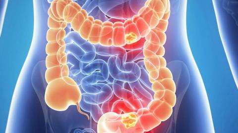 An illustration showing bowel cancer