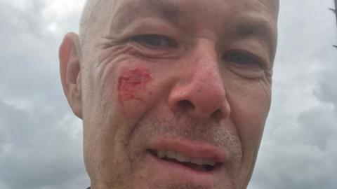 Cyclist Phil Williams with facial injuries afetr the hit and run