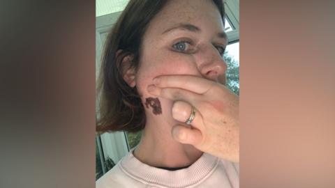 A woman with short brown hair shows a brown mark on her neck.