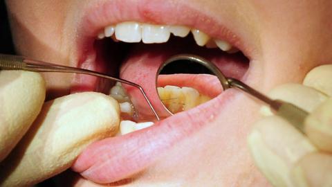 A close-up of a dentist using metal tools to probe into a person's mouth. One of the tools, a mirror, is reflecting the person's teeth back.