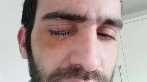 Marc Toone's injured eye