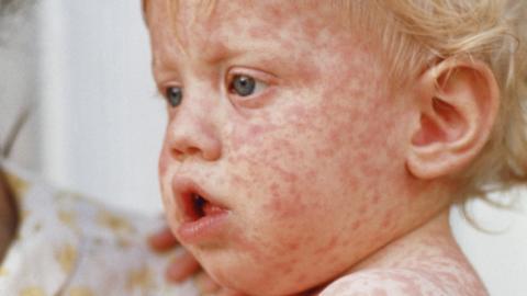 A child with measles