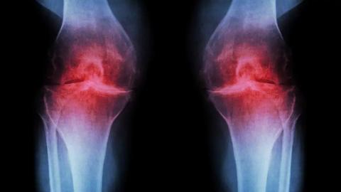 An x-ray of a pair of knees. There are red areas in the knee joints that stand out from the white bones.