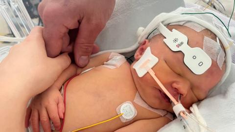A newborn child in a hospital cot with medical equipment on her head and chest.
