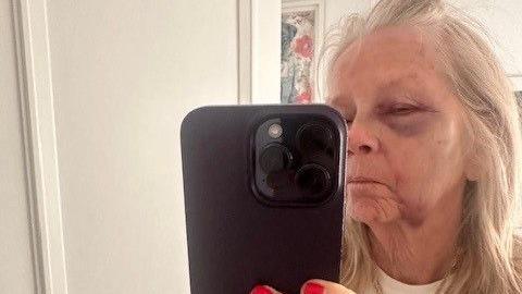 A woman with blonde hair and a bruised face looks into a phone