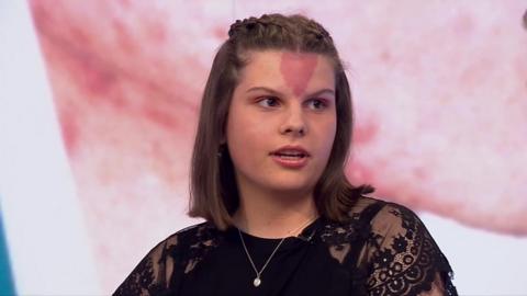 Sophie Parker talks about being bullied for her birthmark.