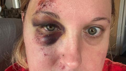 A woman with a black eye and grazed face