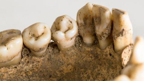 A close-up of ancient teeth showing decaying enamel and jawbone deterioration