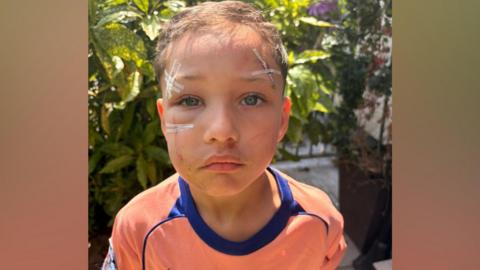 A boy wearing an orange football jersey standing outside in a garden. He has cuts and bruises on his face some taped up.