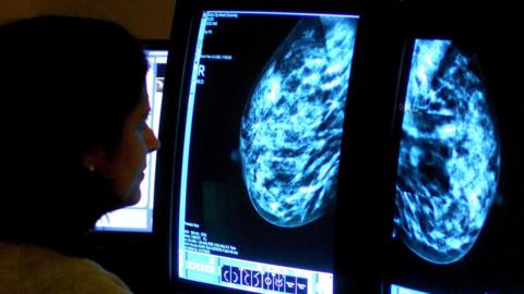 Medic looks at breast scans on screen