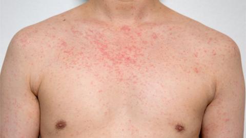 man with measles