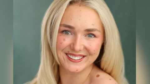 Scarlett Clarke in a head and shoulders photo. She is smiling at the camera and her blonde hair is worn down. She has CMN "satellites" on her face and shoulders of various shapes and sizes.