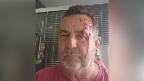 A man wearing a pink shirt in a bathroom. He has blood on his face.