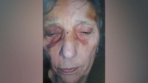 A close up of Iris Scott's face which has visible purple and yellow bruising on her temples and around her eye sockets.