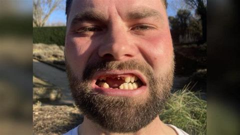 A man with a brown beard close to the camera showing his damaged teeth.