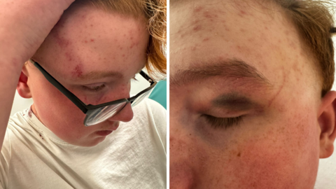 A split screen photo showing cuts and cruises to a teenager's face, and a heavily bruised eye closer up