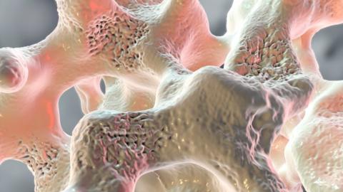 Spongy bone tissue affected by osteoporosis