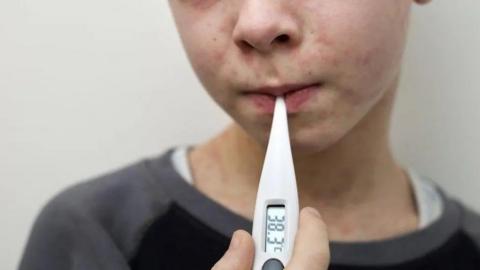 A child with measles has a thermometer in their mouth