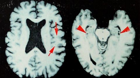 Brain scans of a former NFL player who was diagnosed with CTE