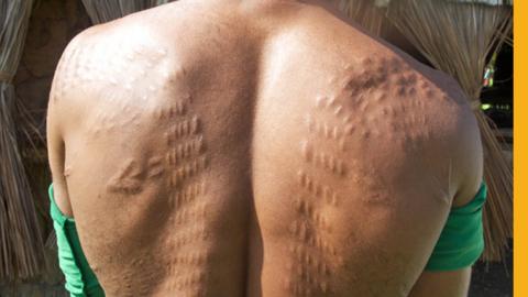Man in Womburn with back scarred to resemble a crocodile's hide