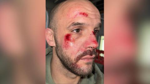 Sam Bevan, a man with a short beard and shaved head is seen from a side view with bright red scrapes to his cheek, nose and forehead.