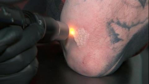 A close up of a red laser dot directed at a tattoo on a man's arm. It is unclear what the tattoo was of, but you can see an area of black ink. Where the laser has already been directed, the skin is slightly raised and white.