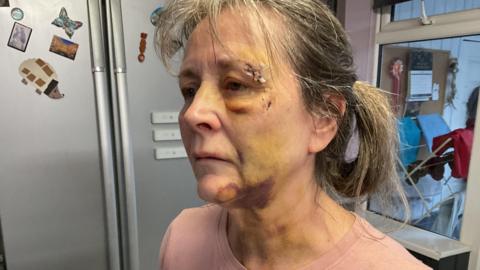 Kay Crisp with injuries to her eyebrow, under her eye, cheek, chin and neck. Black and yellow bruising along with cuts. 