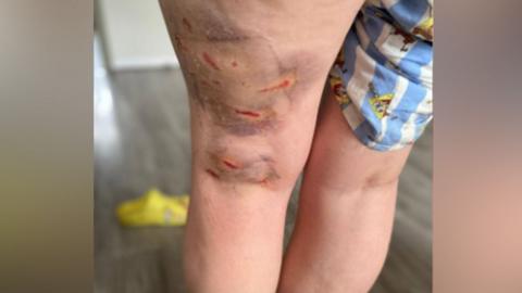 Rosie's legs can be see in the centre of the photo. Her left leg has red marks from fresh scars and heavy dark coloured bruising. On her right leg her blue and white shorts can be seen. There two yellow shoes on the floor.