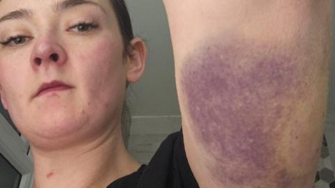 Claire Miller holding her arm up to show a large bruise on her tricep area. Her face is in shot, and she has dark hair/ Behind her are white coloured walls. 