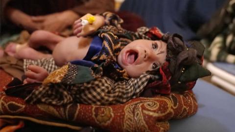 A malnourished baby crying on the hospital bed