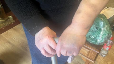 Close-up photograph showing purple and yellow bruising on 71-year-old Stella Kelly's left arm and hand.