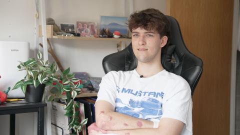Hamish Wilson, wearing a blue and white t-shirt, sits with his arms folded, showing bandages and scars from his latest operations