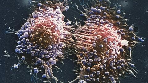 Two prostate cancer cells in the final stage of cell division (cytokinesis