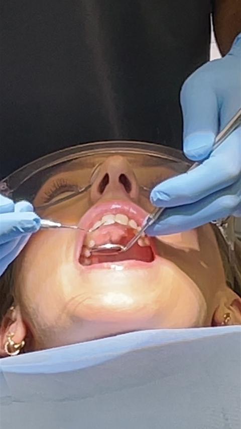 Young woman with mouth open wearing perspex glasses in dentist chair with hands wearing blue gloves and dentist tools in her mouth
