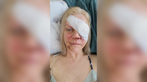 Amber Lewis in hospital after firework discharged in her face