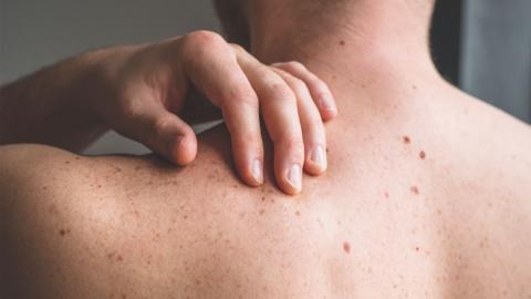 A hand touching the back of a shoulder with bare skin and moles