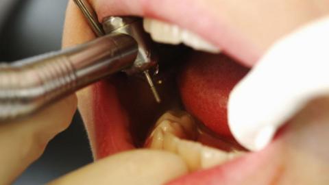 A close up of a child's mouth at the dentist - the dentist's fingers, with white gloves on, are visible, along with a drill