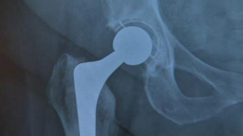 Hip joint x ray