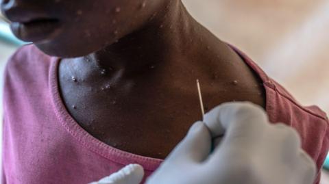 A gloved hand holds a needle close to the neck of a child whose chin and neck have raised lesions