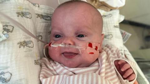 A baby with a drip up its nose is smiling. She is wearing a striped top and is lying on a pillow with rabbits on it