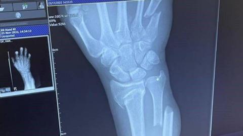 An X-ray, showing several fractures to bones in a person's right arm