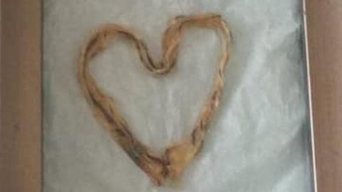 A framed picture containing a human umbilical cord shaped like a heart